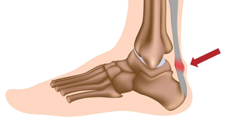 Achilles tendon and Achilles tendonitis