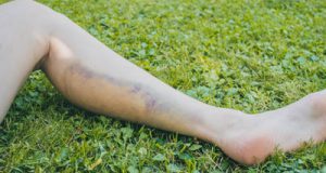 calf pain and worst calf stretches