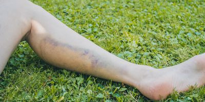 calf-pain calf pain and worst calf stretches